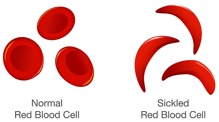 Sickle Cell Disease Symptoms and Treatment -  Mothersfoundation