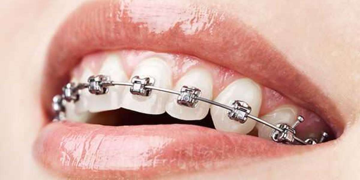 Get Orthodontic Treatment at AK Global Dent