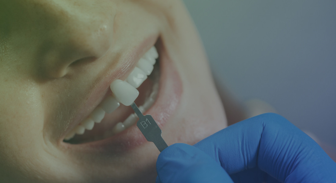 Dental Veneers - All You Need to Know About it