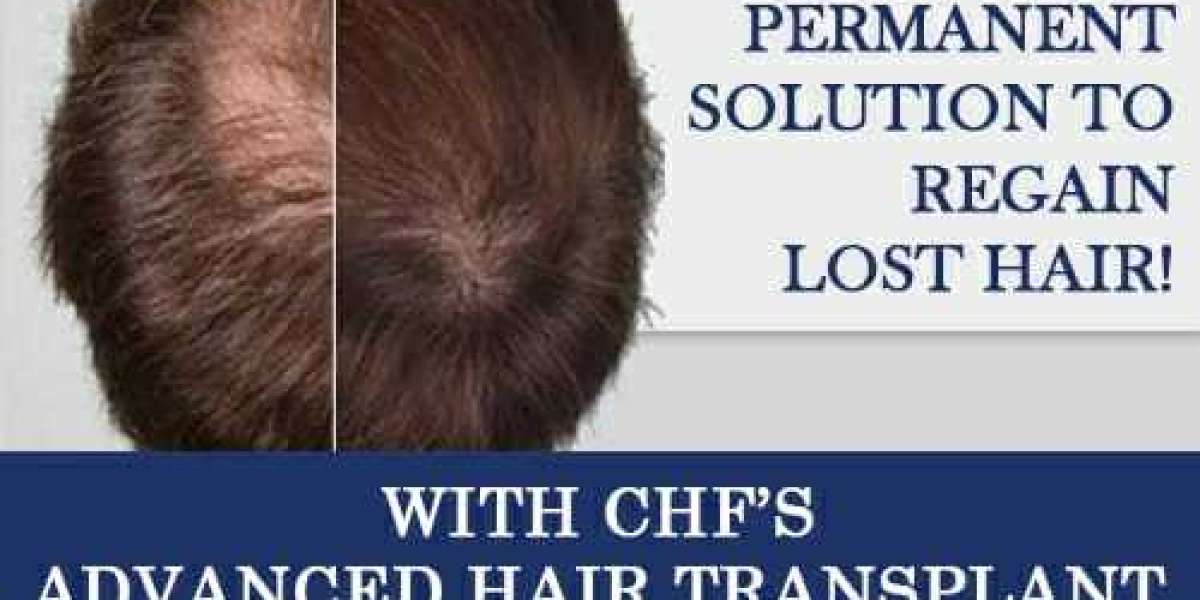 What does happen lifer after hair transplant: