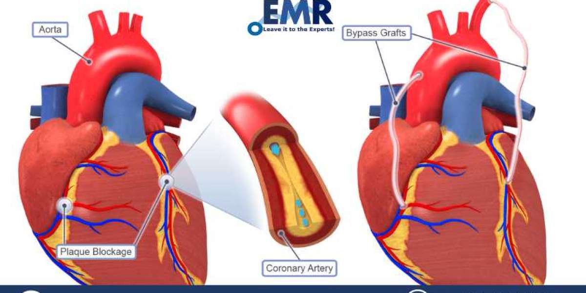 Coronary Artery Bypass Graft Procedures Market Size, Growth, Demand, Forecast 2023-2028