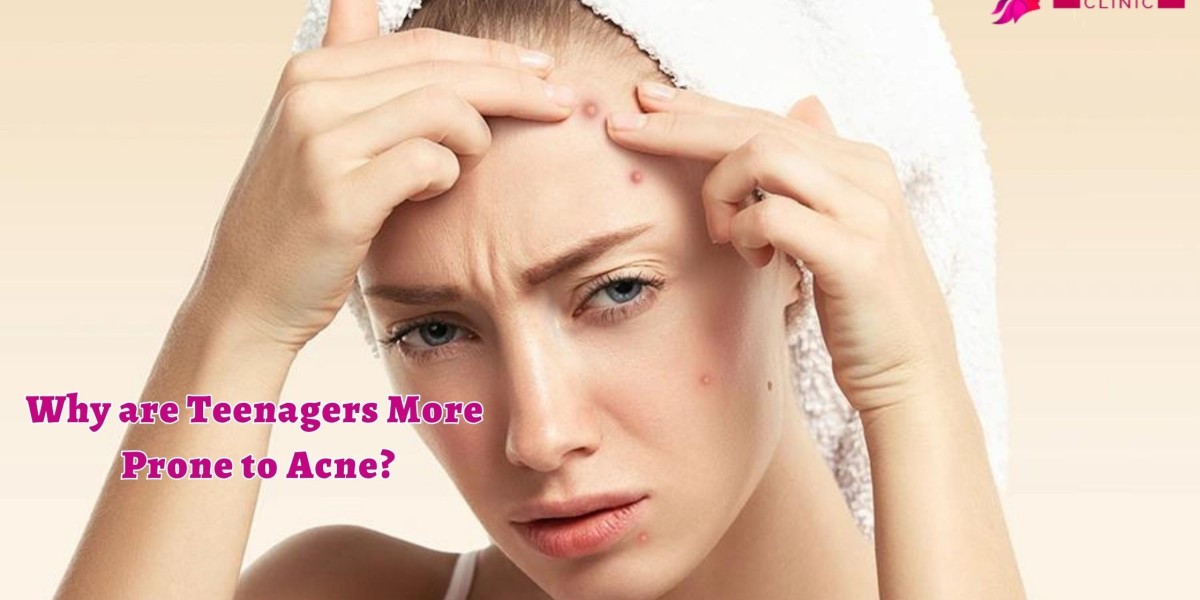 Why are Teenagers More Prone to Acne?