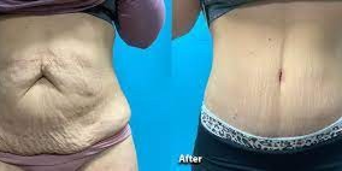 Tummy Tuck - Recovery Time and Recovery tips