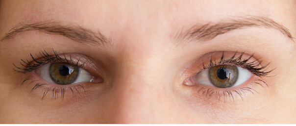 Ptosis or Droopy Eyelids