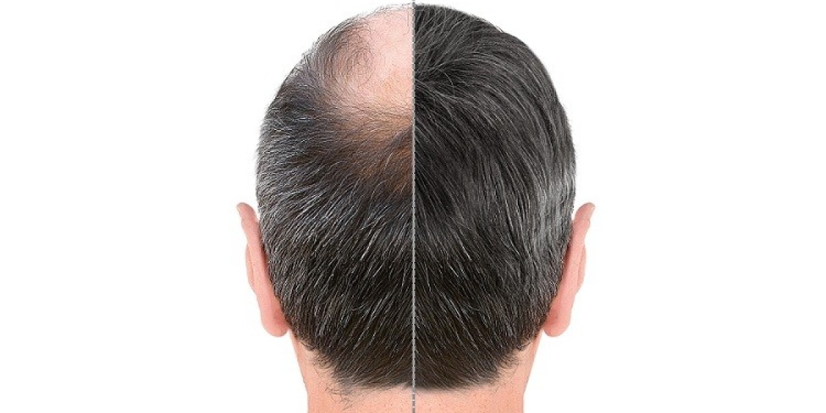 What is the cost of a hair transplant in Delhi?