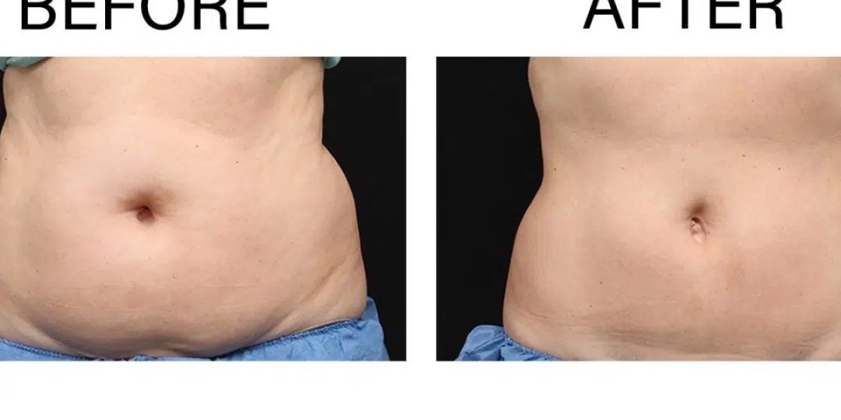 CoolSculpting: A Comprehensive Guide to Non-Invasive Fat Reduction
