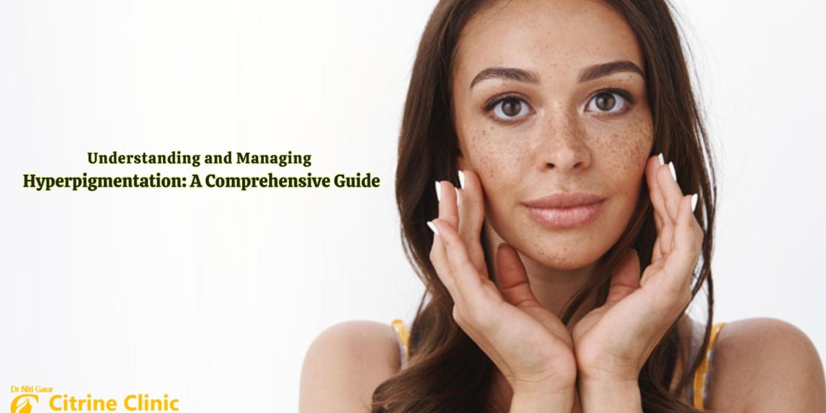 Understanding and Managing Hyperpigmentation: A Comprehensive Guide