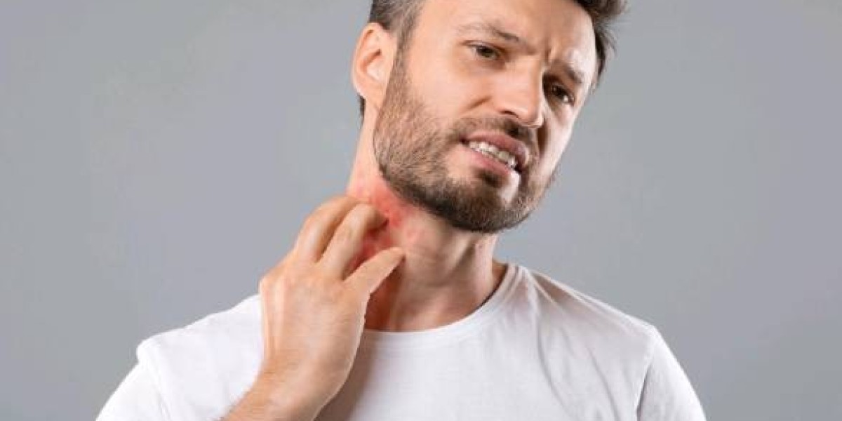 Eczema Treatment In Dwarka