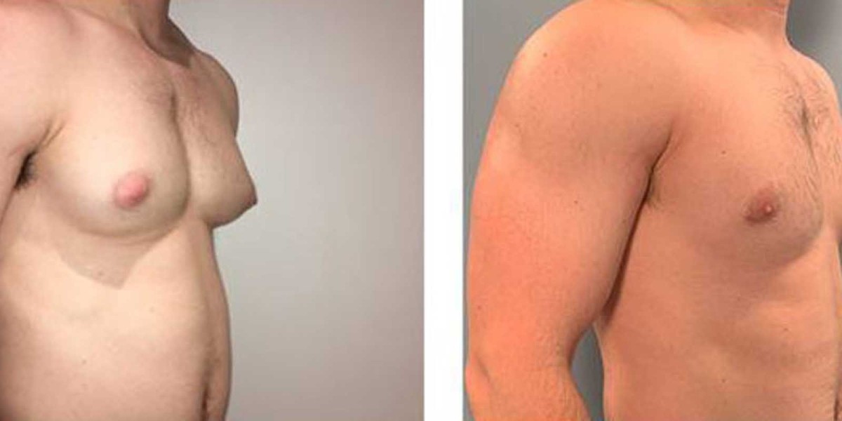 A Quick Guide to Male Breast Reduction Surgery