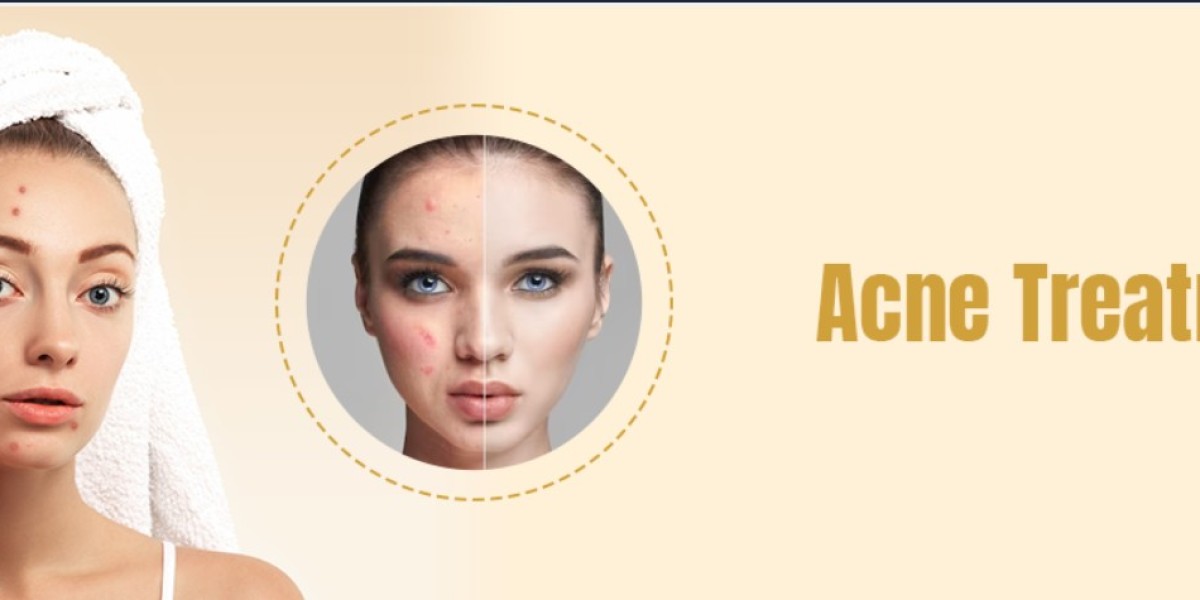 Acne Treatment In Delhi