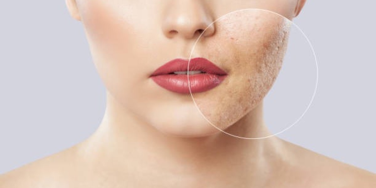 Consider Delhi Dermal Filler Treatment and Say Goodbye to Acne Scars
