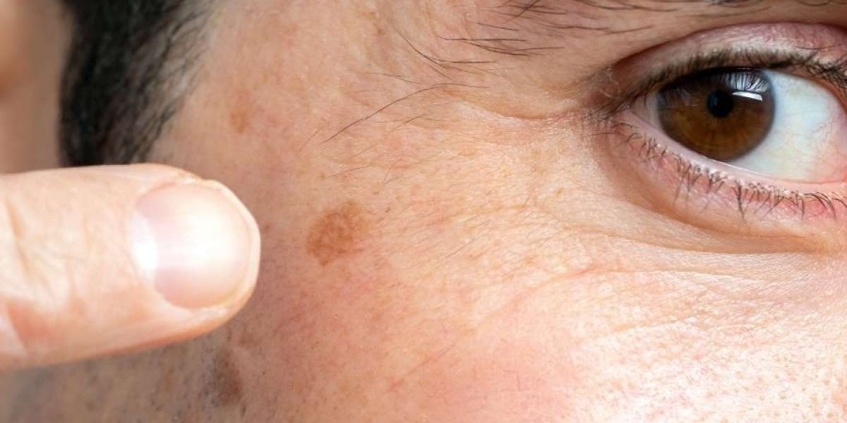 black spots on skin