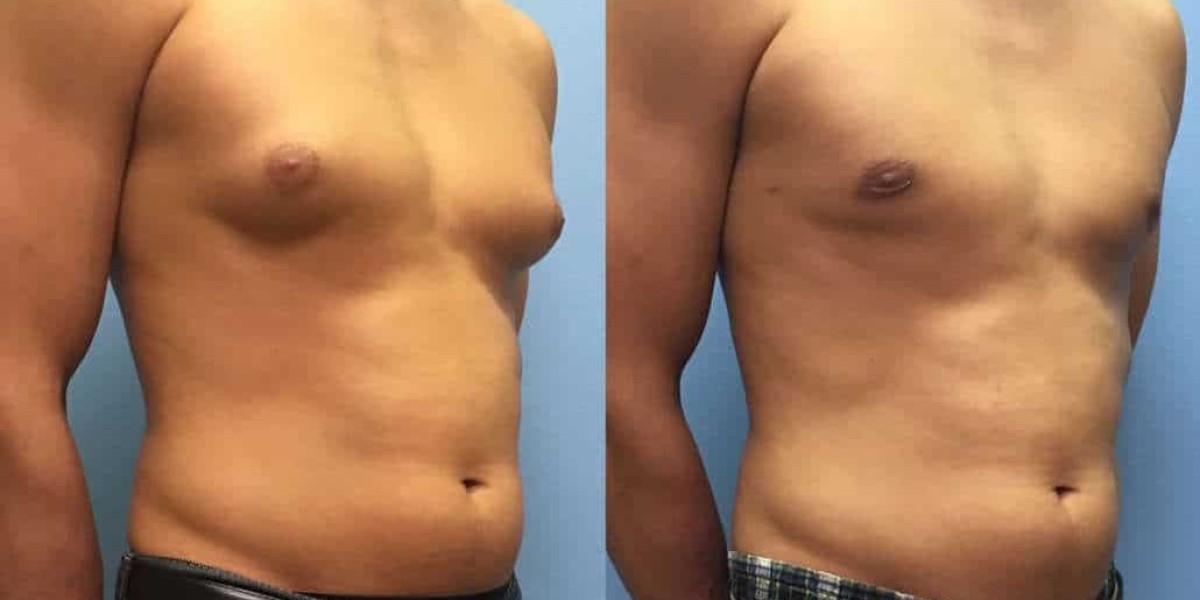 how much does gynecomastia surgery cost