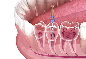 Best Root Canal Treatment in Al Ain | Al Andalus Medical Center
