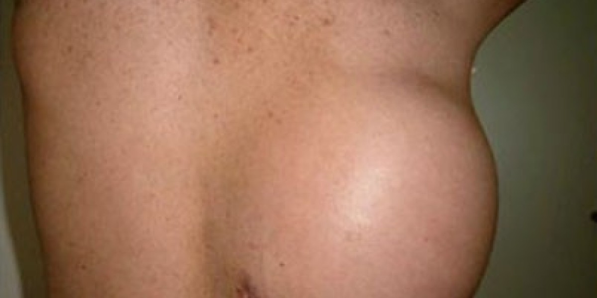 Chest Wall Tumor Treatment in Gurgaon