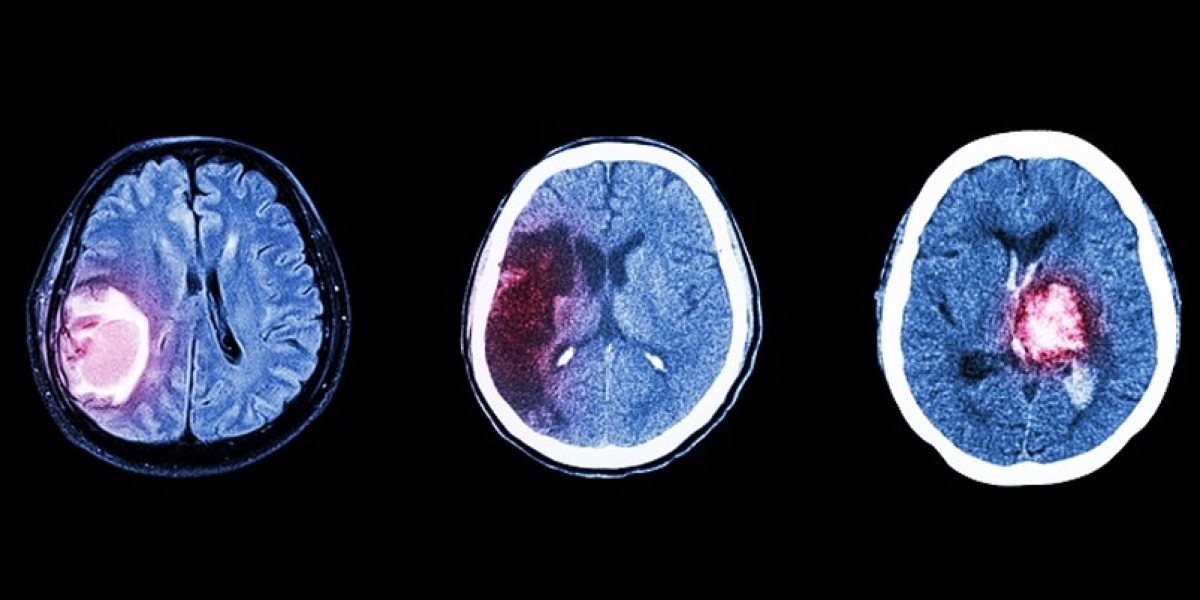 Empowering Patients Understanding Brain Cancer Treatment Options