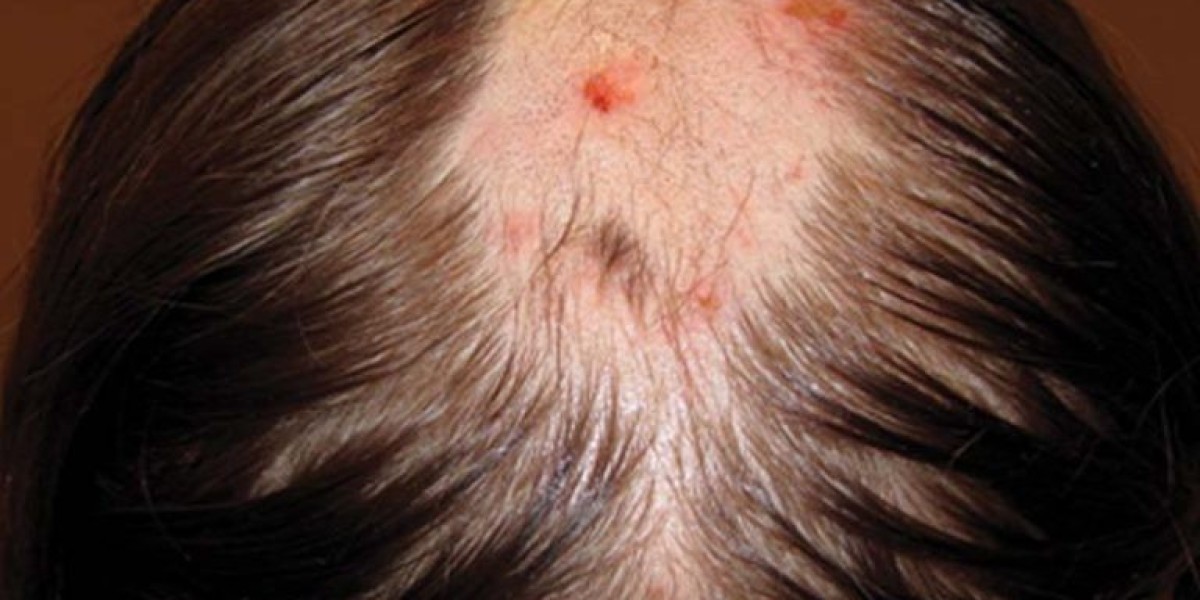 Why Is My Scalp Tender In One Spot? Causes And Medications