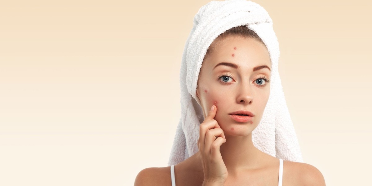 Acne: It’s Causes & Effective Treatments