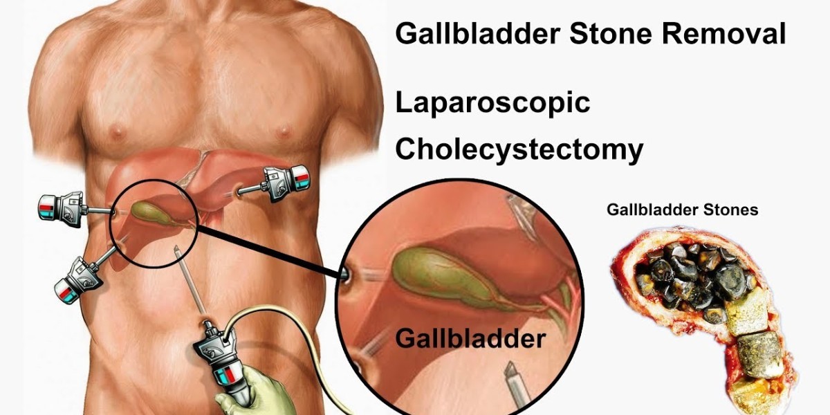 gallbladder treatment In delhi
