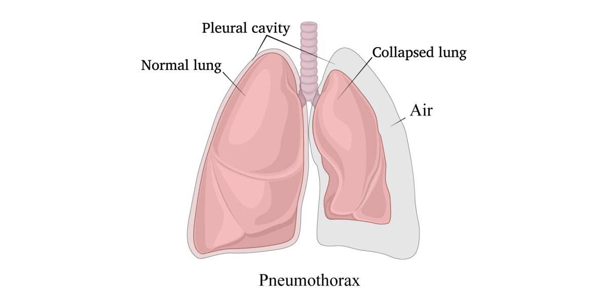 Pneumothorax Treatment Cost in India