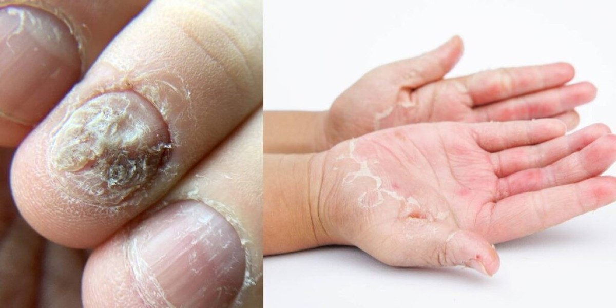 Is Psoriasis A Fungus
