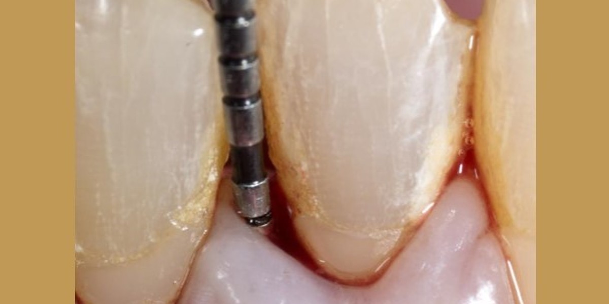 Dental implants cost in Cochin