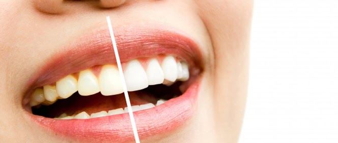 Aftercare Tips For Teeth Whitening Bankstown