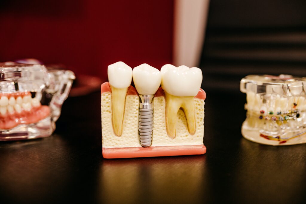 How To Choose The Best Dental Implant Clinic In Noida - Mirror Eternally
