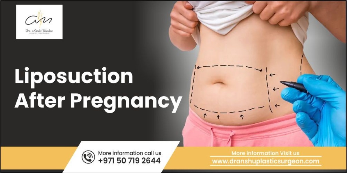 Liposuction After Pregnancy: Importance, Recovery and More