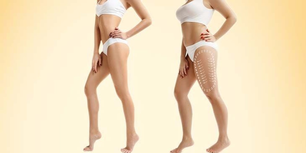 Liposuction Treatment in Dubai