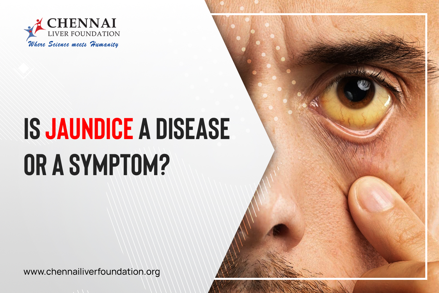 Is Jaundice a disease or a symptom? - Chennai Liver Foundation