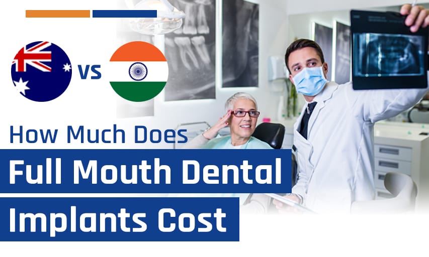 How Much Does Full Mouth Dental Implants Cost Australia vs India?