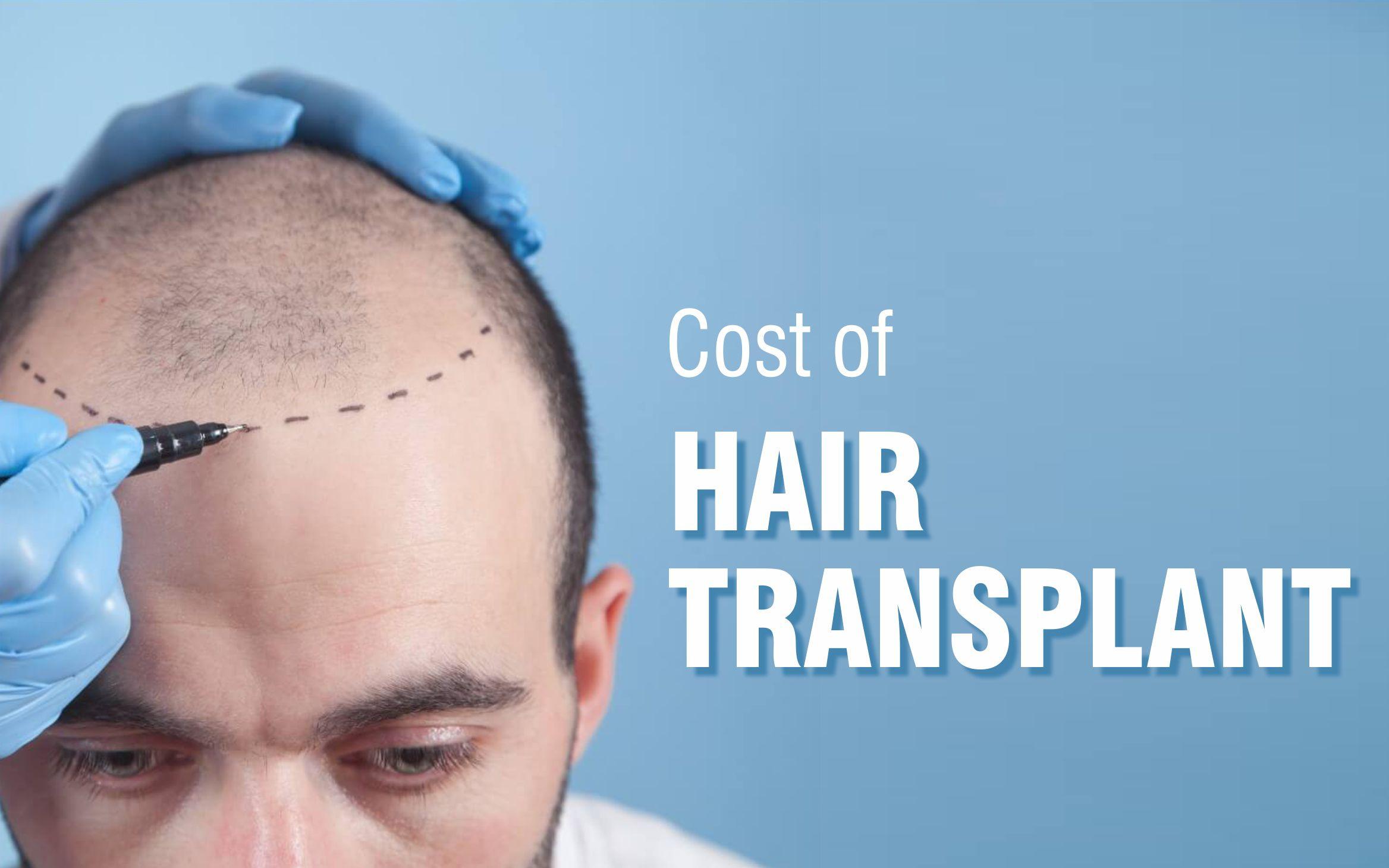 Why Mumbai Is A Hub For Hair Transplantation?