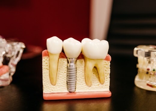 Transform Your Smile With Dental Implants In Malvern