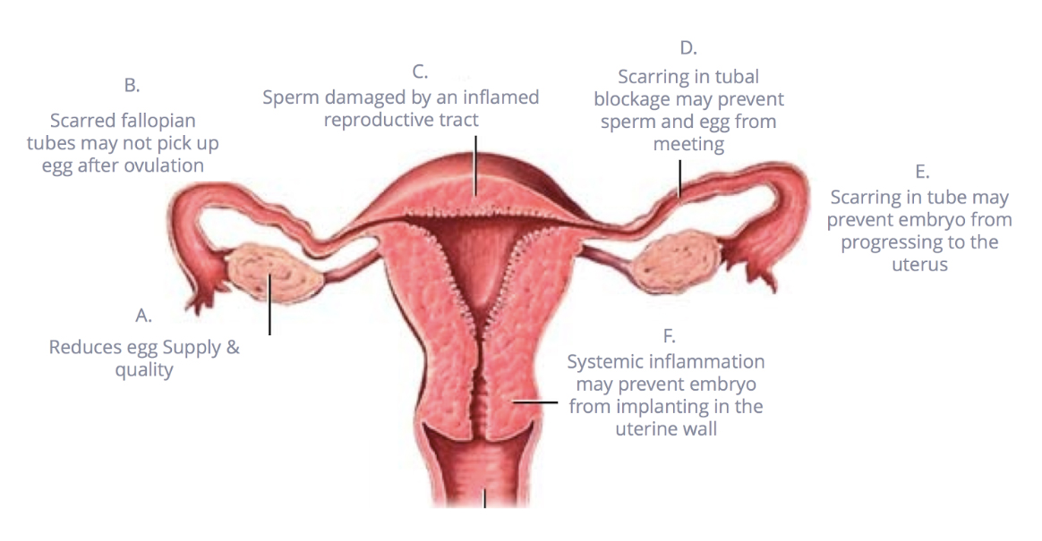Treatment for Endometriosis: Managing Symptoms & Enhancing Fertility | AFGC