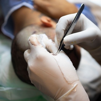 Hair Transplant in Islamabad Pakistan - Enfield Royal Clinics