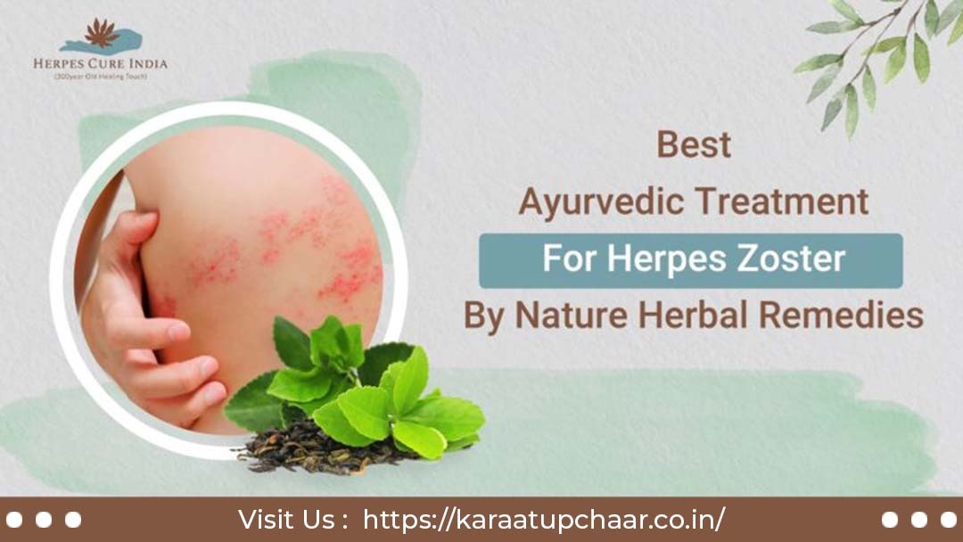 Best Ayurvedic Treatment For Herpes Zoster by Nature Home Made Oil's
