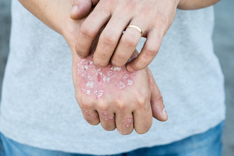 Eczema - Premium AllergyPremium Allergy