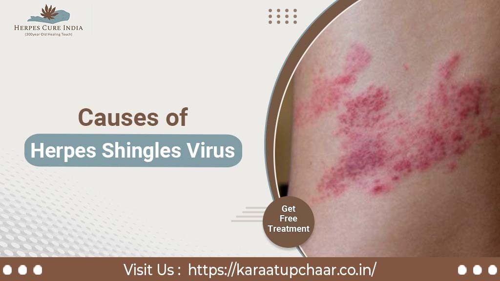 Herpes Shingles Virus and its Cause